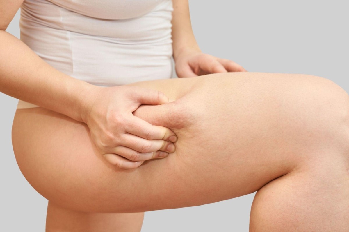 Nouveau Dermé Introduces Body Contouring Program